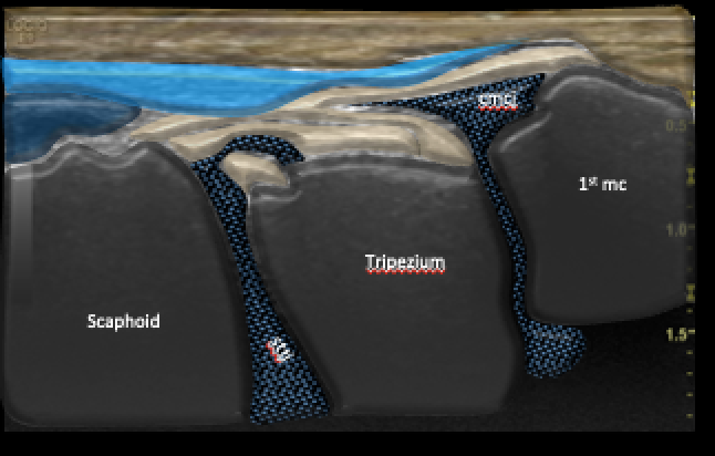 

Sagittal anatomy CMC and STT joints

